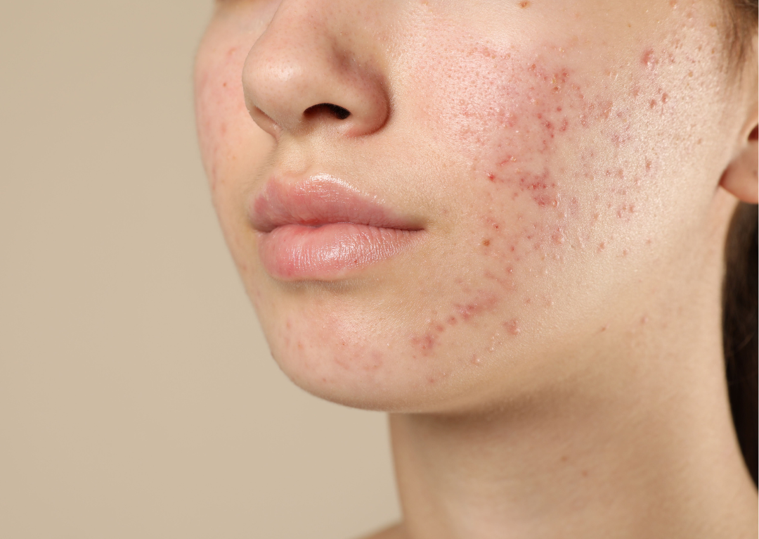 The Science Behind Clear Skin: How Your Gut Microbiome Controls Breakouts