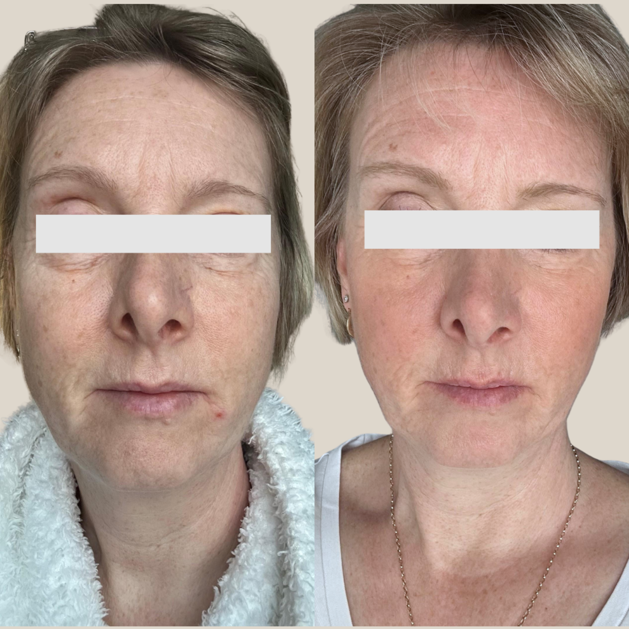 Visibly reduced redness result