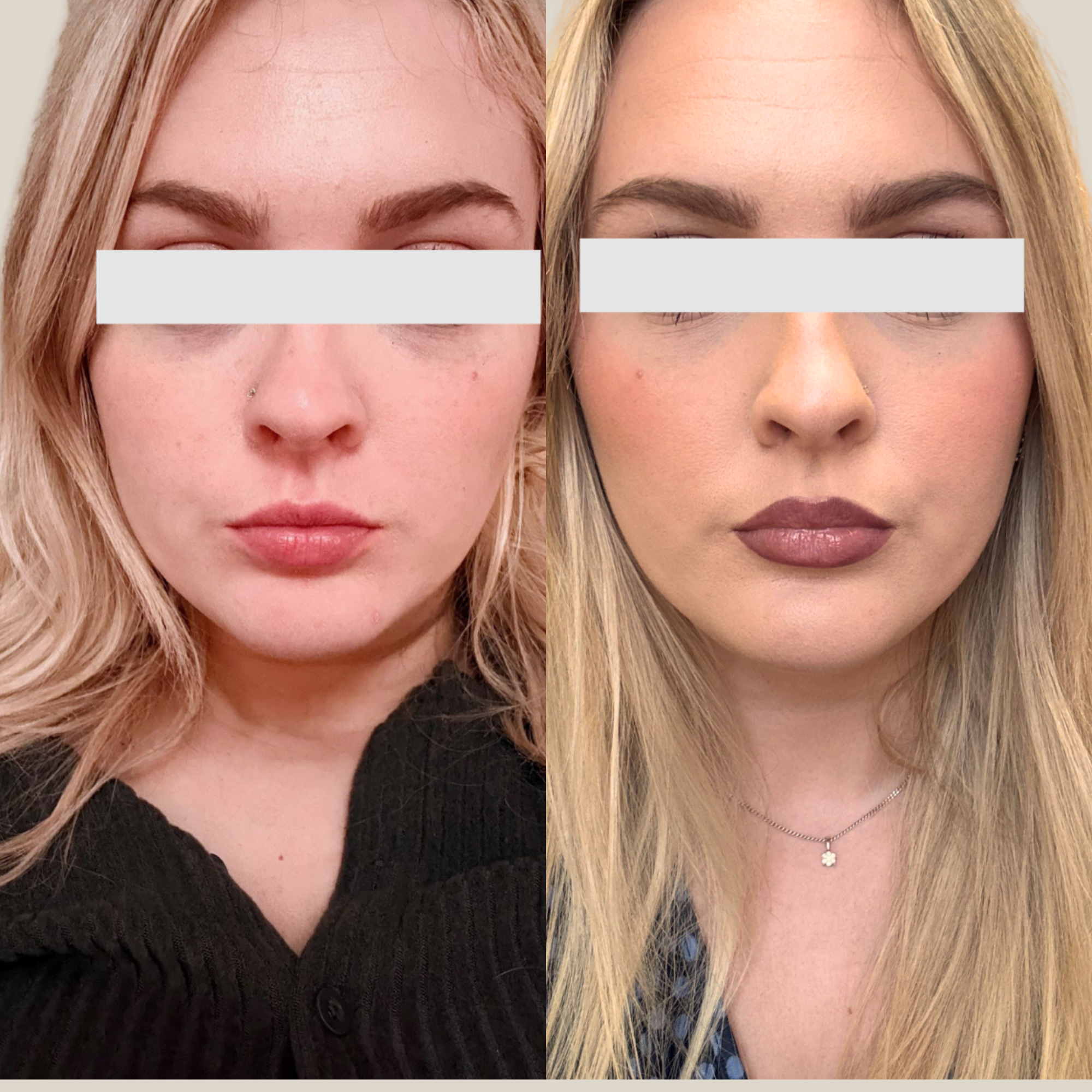 Fewer breakouts, smoother skin result